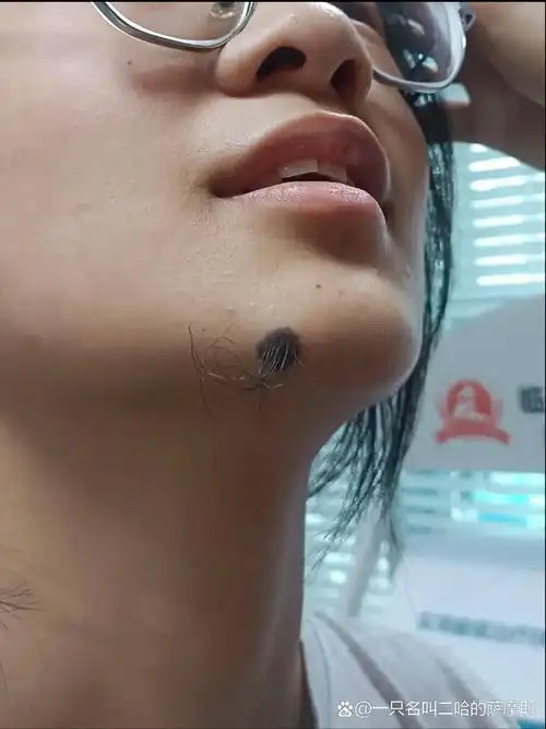 长毛痣上面长毛女人下巴有痣长毛图解痦子毛为什么痣上面会长毛长毛痣
