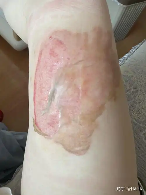 烫伤自我在家换药过程 - 知乎