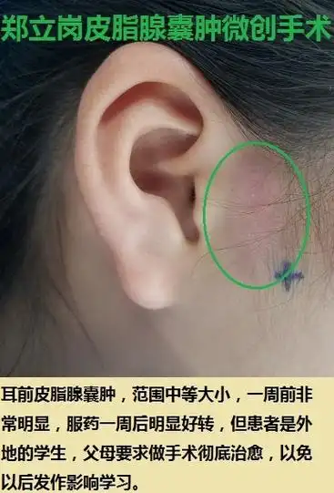 囊肿的患者,1周前来找我,但当时有明显的红肿发炎,我建议先药物治疗