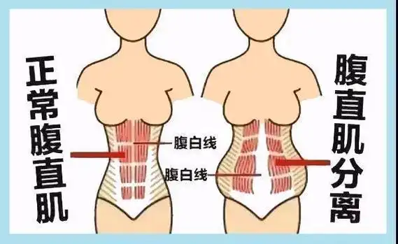 如何消除产后大肚子?