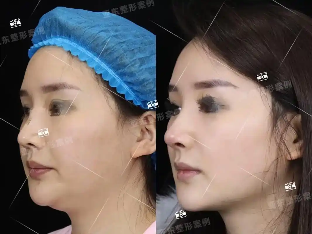 医美圈都说手术在断崖式减少微整形在崛起…… - 抖音