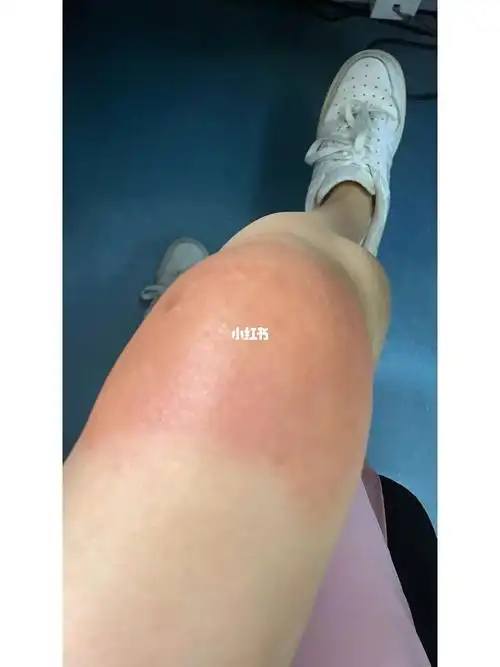 过敏性皮炎一条龙,作死经历