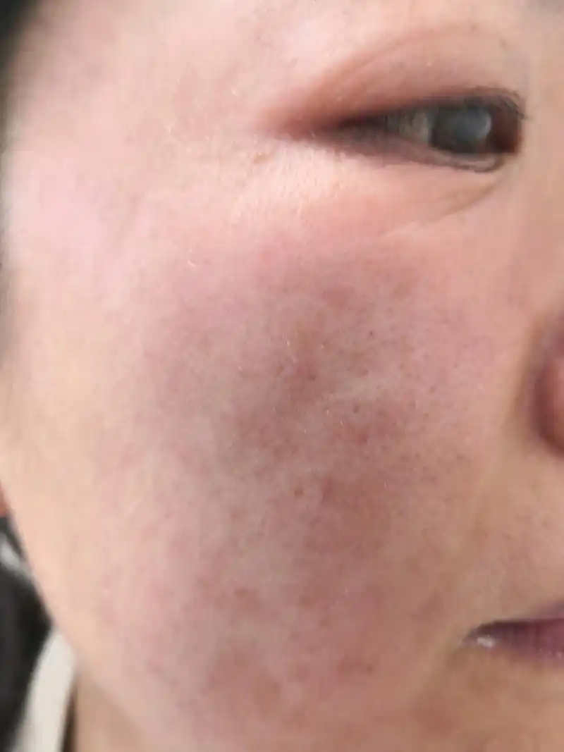 过敏#使用化妆品过敏的这么多是为什么?#解决皮肤问题专注皮肤美容