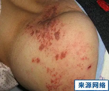 艾滋病带状疱疹图片