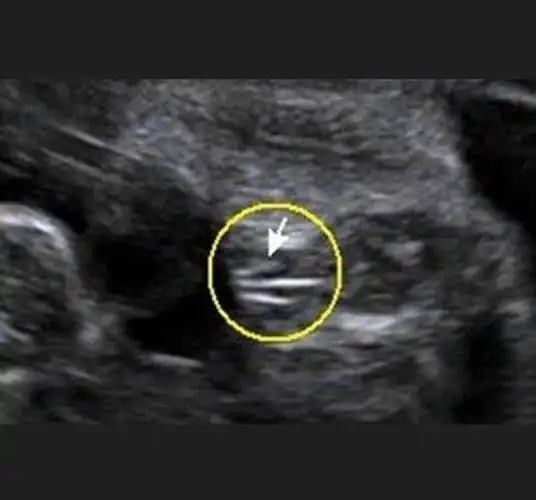 二维彩超报告三条线看胎儿是男是女的方法准吗