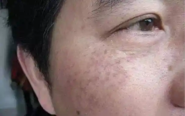 皮肤上看到一颗 其实皮肤底下已经一窝了 所以怎样才会 长斑? ▽