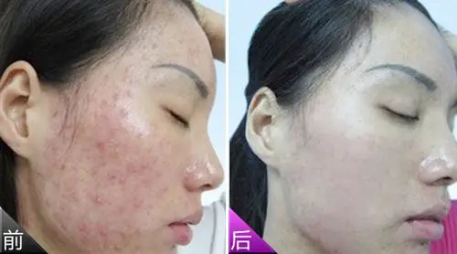 粉刺项目前后对比图