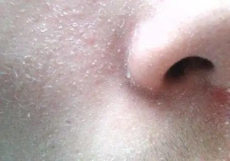 亲们, 脸干 起皮 爱泛红 角质层变薄了用什么护肤品?谢谢了?