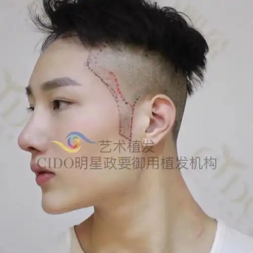 熙朵aht艺术植发