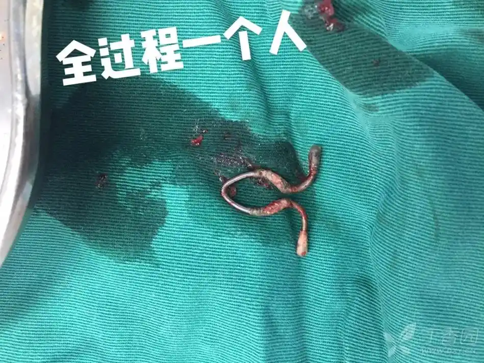 除了生孩子的苦,还有一种痛叫"取环"那种铁丝层层绕过肉有多疼 - 抖音