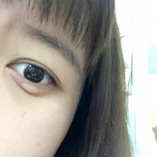 眼袋下突然肿起一个包,很痒.怎么回事(不是蚊子咬的)