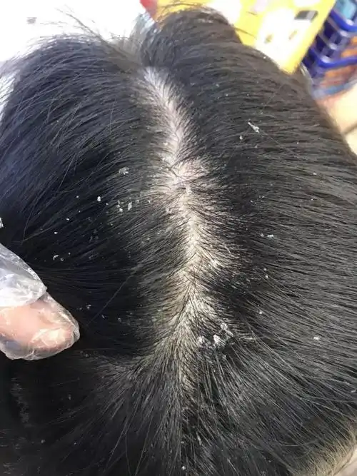 头皮屑的知识与防治