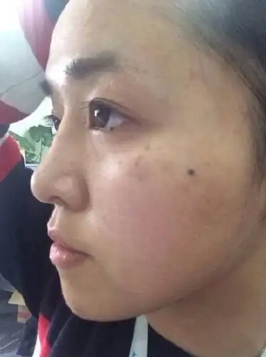 有这2个症状,说明黄褐斑要来了,这样做可以抑制它的出现