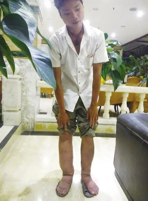双腿肿如象腿面临截肢危险