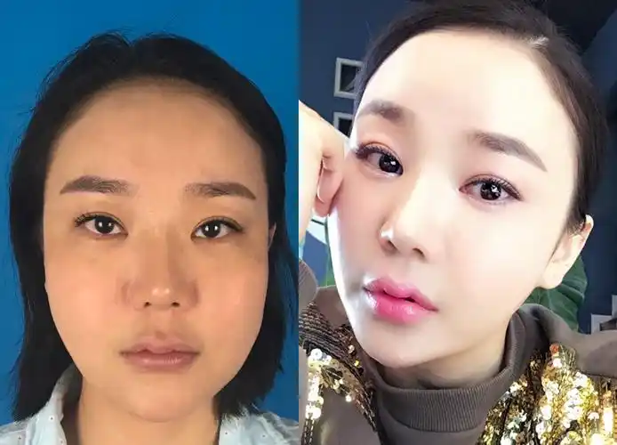 术后三个月的对比照片;全面部脂肪移植就是大家所说的自体脂肪填充