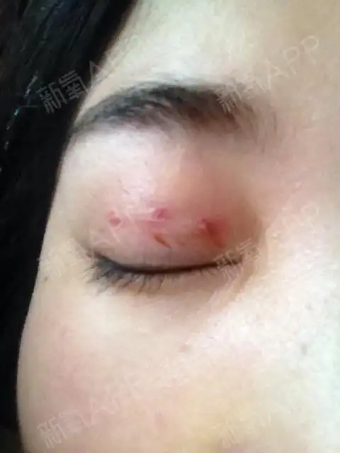 拆线后线结反应很大一块鼓包直接是6个窟窿