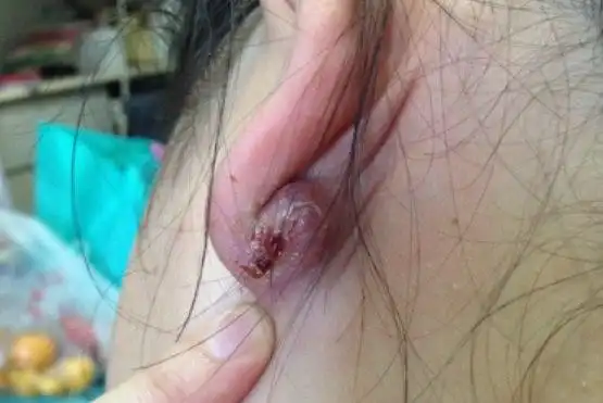 耳垂皮肤疖肿