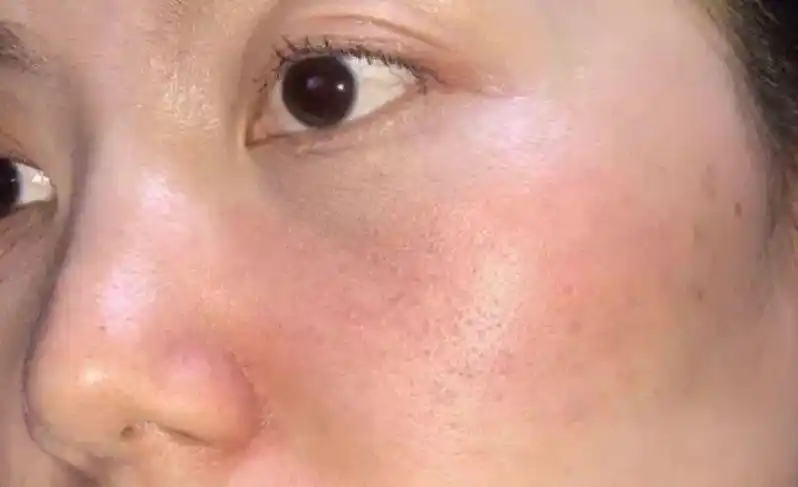 用护肤品刺痛是皮肤缺水,皮肤表面干燥开裂是缺水,皮肤油脂分泌太旺盛