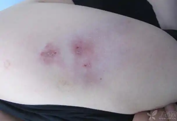 【请教】狼疮性脂膜炎