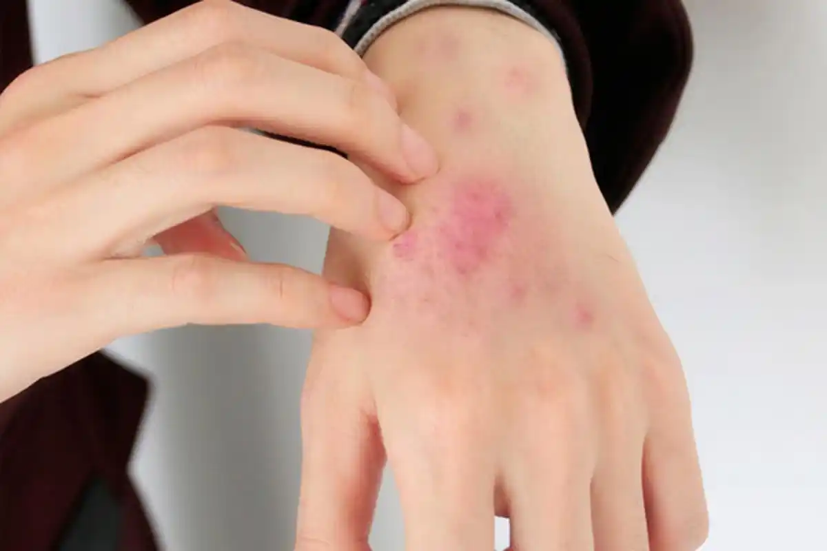 通过询问病史,也可以做一下过敏原检查.3.