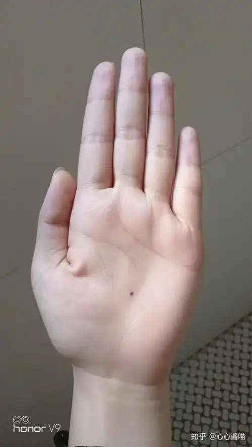掌心有痣是什么体验?
