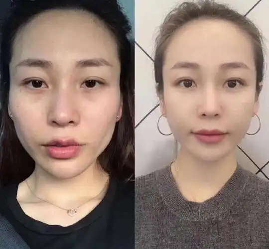 想做面部抗衰,轮廓固定和面部填充两者之间的差别在哪里?