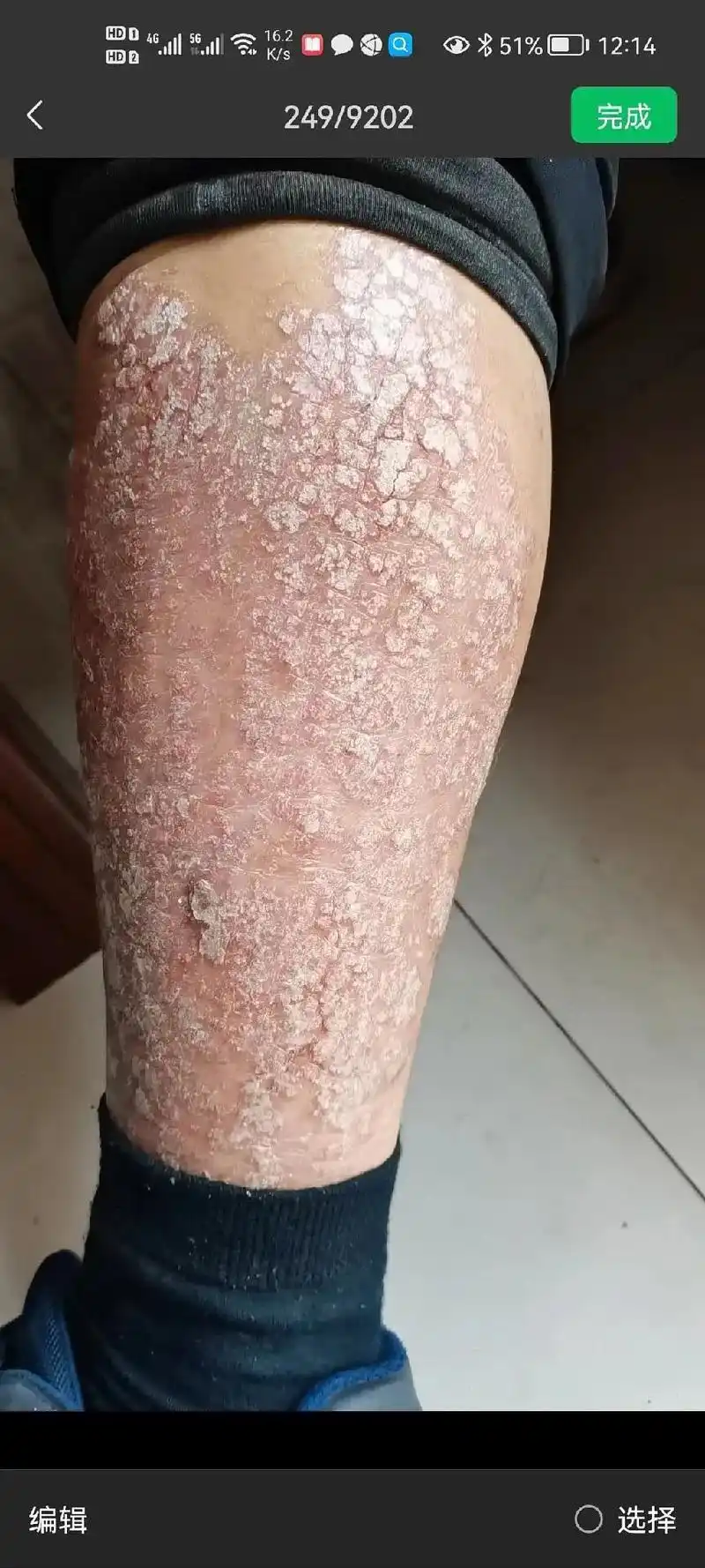 头癣,脚癣,各种皮肤病,庠,庠,痒#田阳同城 ! - 抖音