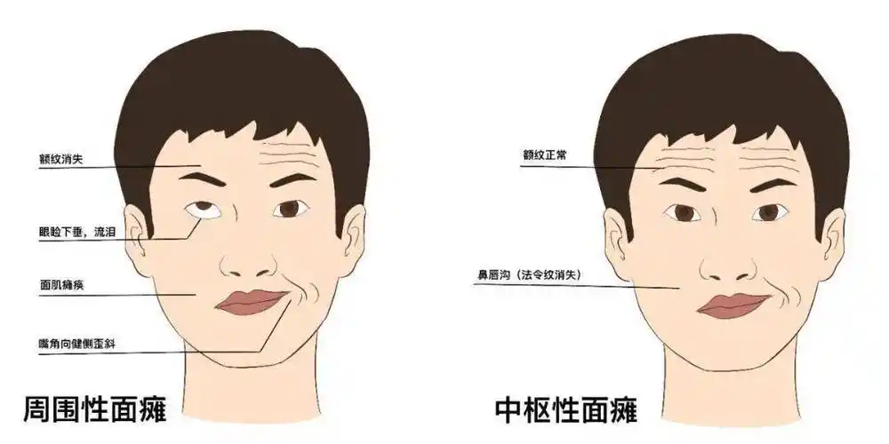 面部失控|揭开面神经炎的神秘面纱!