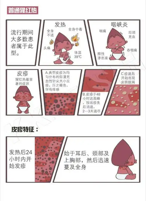 ③皮疹:皮疹是猩红热最显著的症状.