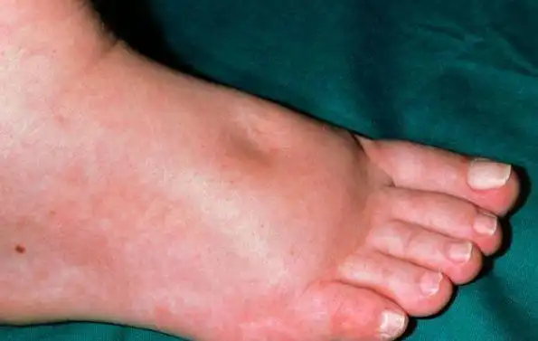 身体出现哪些症状就要警惕尿毒症了一文为你说清