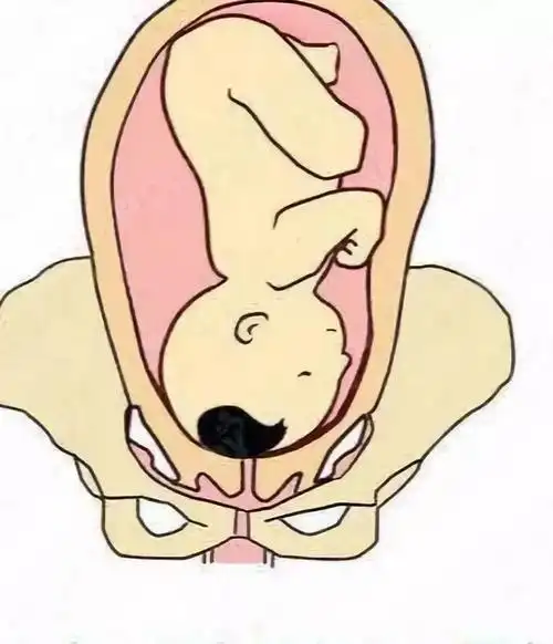 04头部向下——头位当胎宝宝的头部朝着宫口方向,就属于头位胎儿,头位