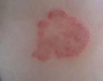 的疾病,是严重影响人民健康的常见病,多发病之一,如麻风,疥疮真菌病