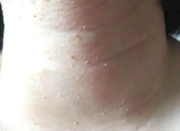 露脖季,别让丝状疣毁了你的玉颈 - 竹溪县人民医院官网