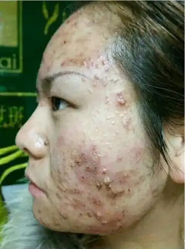 满脸痘痘没想到还有治愈的一天,看我2个月祛痘奇迹