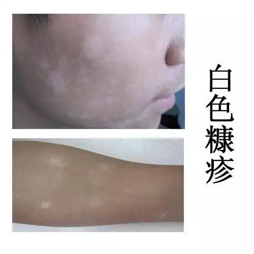 白色糠疹又名单纯糠疹,面部干性糠疹,大家又叫它"桃花癣","蛔虫斑".