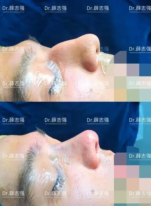 内入路保留鼻整形丨外国帅哥的驼峰鼻矫正