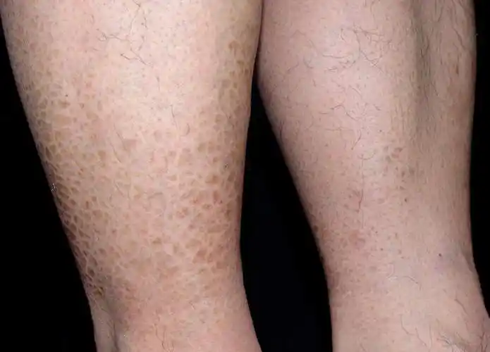 小腿和大腿都这样 该怎么治