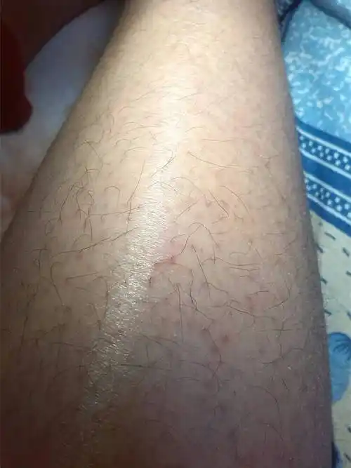 我的腿部有类似毛囊炎的症状,痒但是不痛,不知道是不是毛囊炎,另外