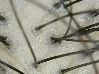 一个毛囊里多少头发才是正常的