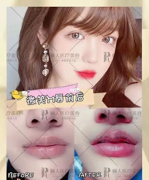 都是可爱的嘟嘟嘴93,性感嘴唇,精致小姐姐94 67#赣州俪人整形