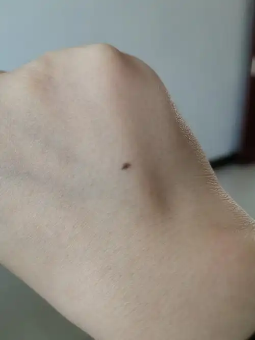 笔芯扎到肉里面,伤口已经愈合但是有一个小黑点怎么办? - 知乎