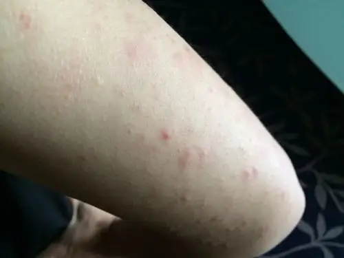 手臂上长的是什么啊?挤的话就有白色的东西,都好几年了.