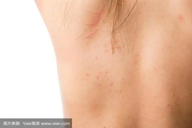 湿疹皮肤的人体背部细节纹理