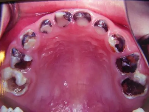 有哪些食物可以预防蛀牙