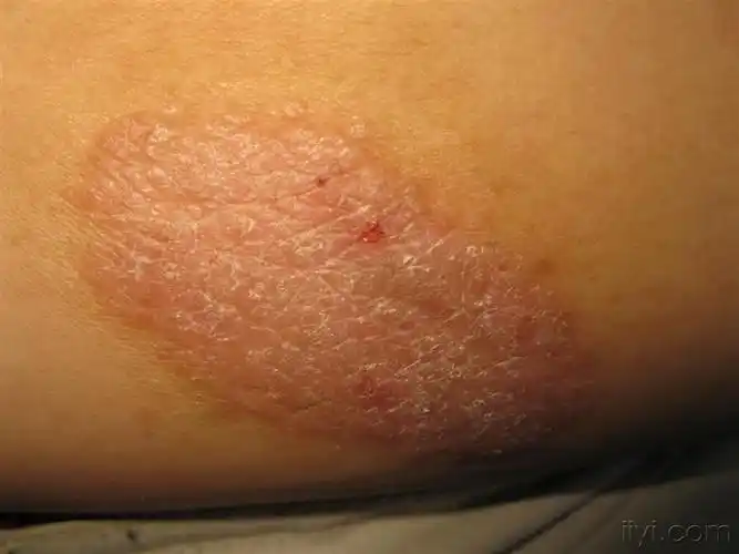 泛发性神经性皮炎 - 皮肤及性传播疾病讨论版 - 爱爱医医学论坛