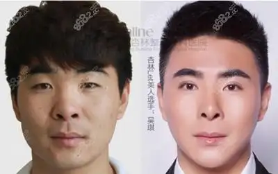 沈阳杏林整形外科医院男生割双眼皮前后对比图