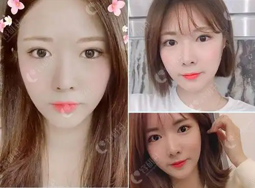 单眼皮妹子破茧成蝶一次双眼皮整形圆她美丽新娘梦