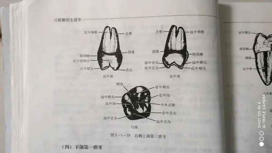 右侧上颌第三磨牙