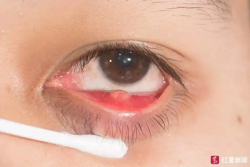 医界大诊探| 直接用手挤麦粒肿?医生:小心引起颅内感染