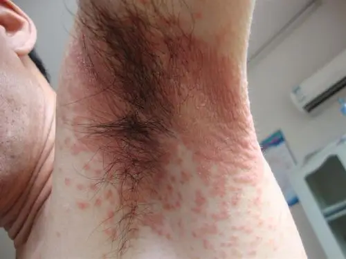 成人皮肤念珠菌病